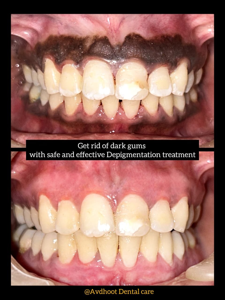 Smile Makeover