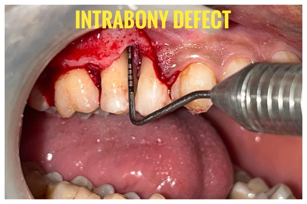 Periodontal disease treatment